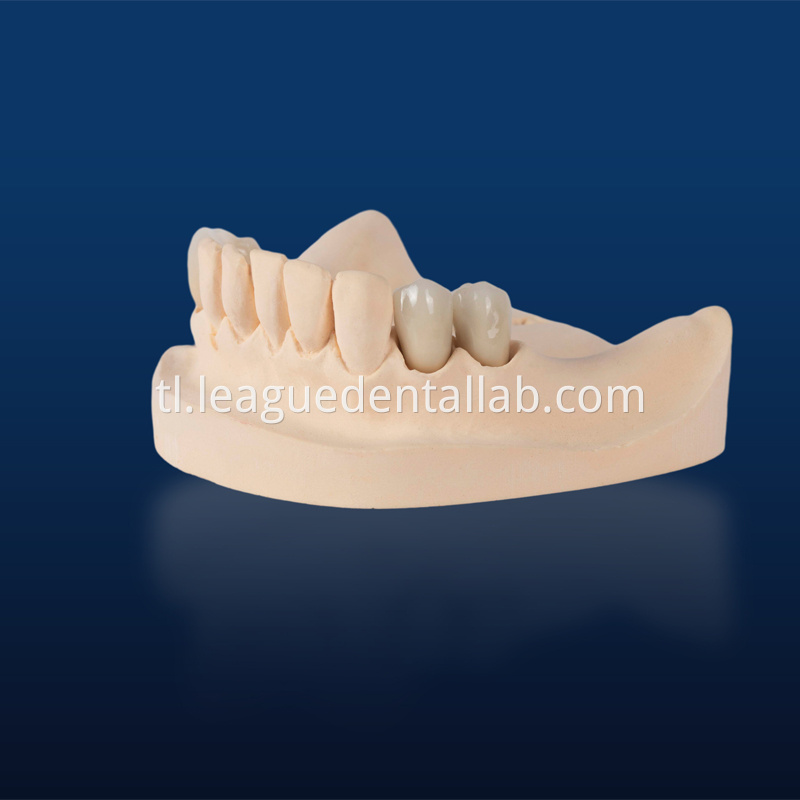 PFZ,Porcelain Fused to Zirconia,Zirconia Layered, Zirconia Veneered